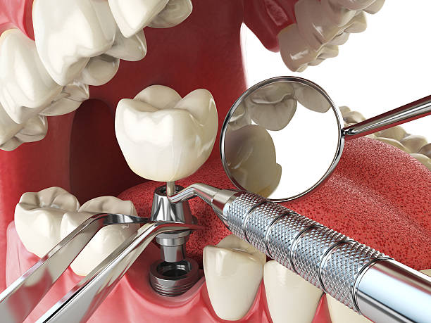 Best Emergency Denture Repair in Vista, CA